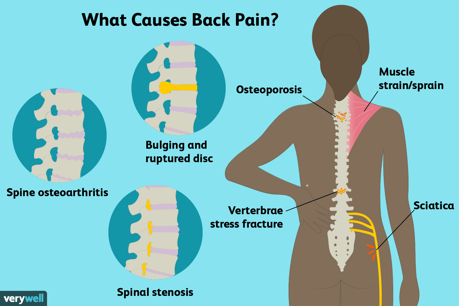 what causes back pain?